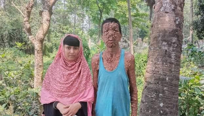 বিরলরোগে আক্রান্ত আনোয়ার স্বাভাবিক জীবনে ফিরে যেতে চায়