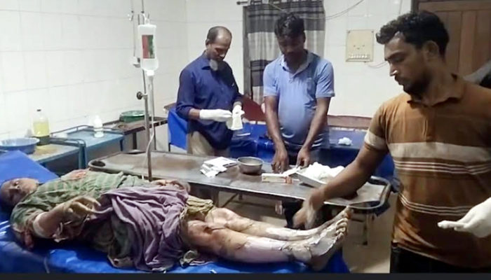 মতলব দক্ষিণে গ্যাস সিলিন্ডার বিস্ফোরণের ৬ দিন পর ১ জনের মৃত্যু